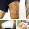 挫傷治療の紹介写真