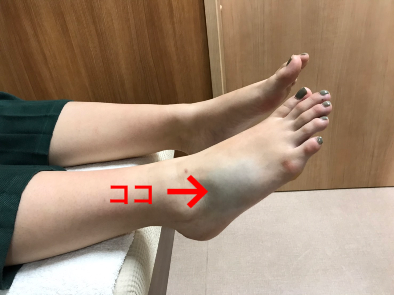 足首の骨折と捻挫はどうやって見分けるのでしょうか?