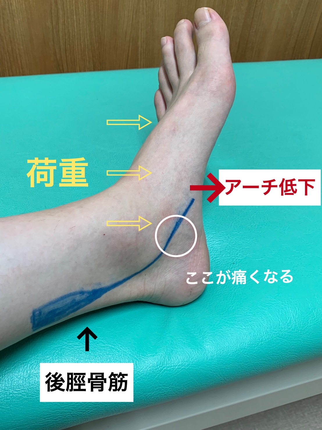 後脛骨筋腱炎 足首内側の痛みの原因は 長崎市のはしぐち整骨院 日曜営業 交通事故治療 足底筋膜炎
