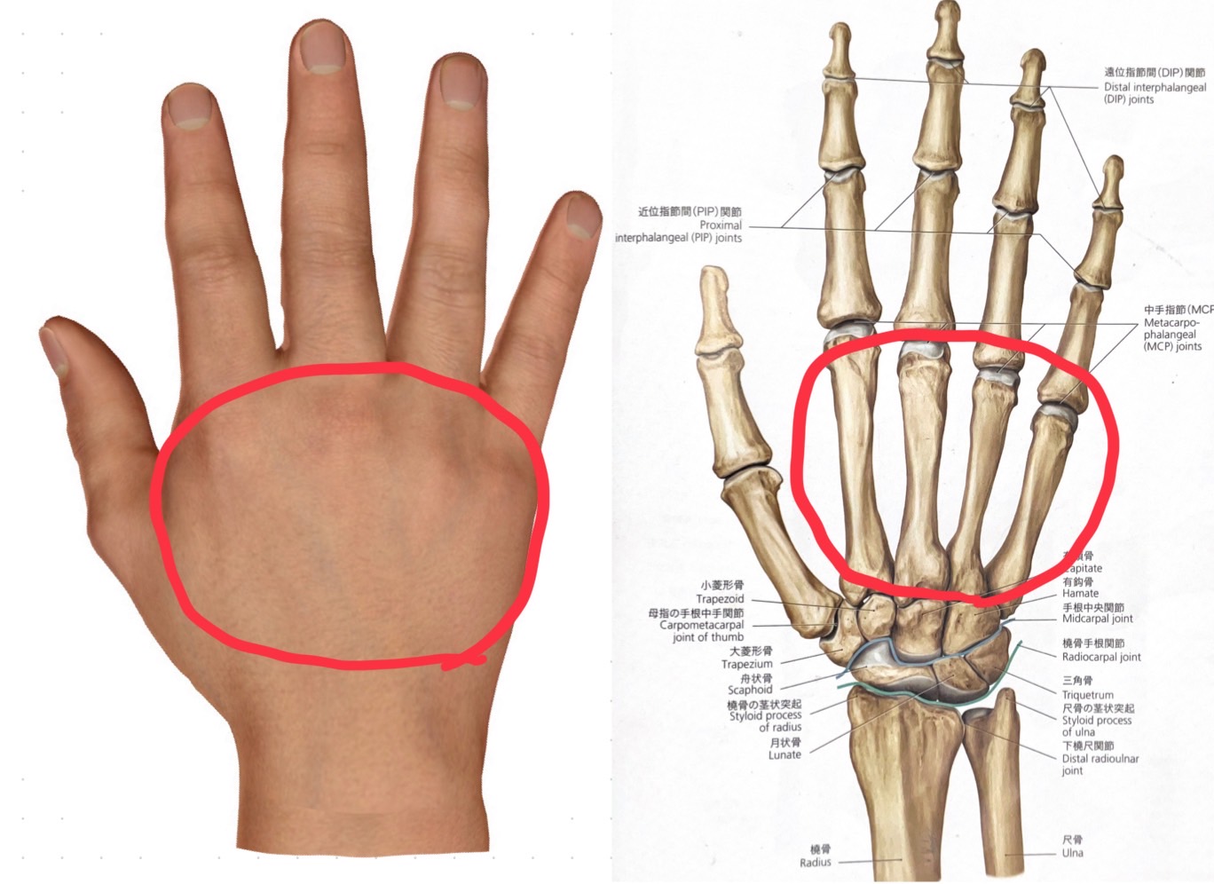 バスケットボール🏀中に相手と接触して、手の甲の骨、第5中手骨を骨折